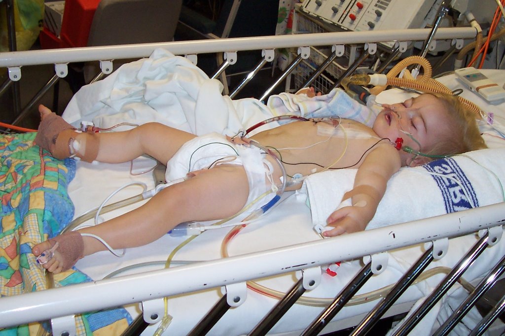 post open heart surgery at Westmead Children's Hospital Sydney